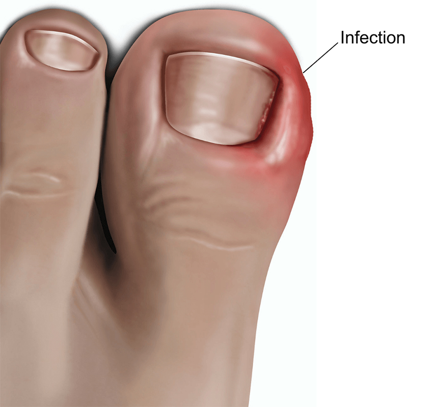 ingrowing-toenail-image